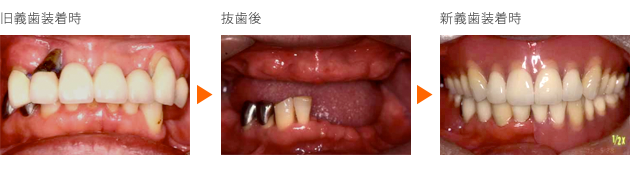 入れ歯症例