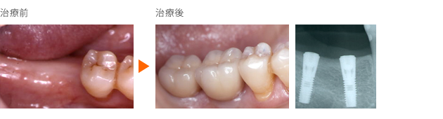 インプラント症例